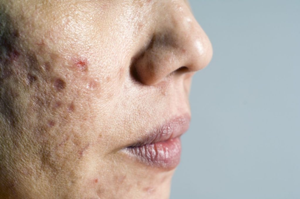 5 erreurs à éviter quand on a de l’acné
